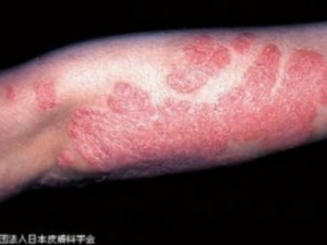 骨粗鬆症乾癬とは何ですか?